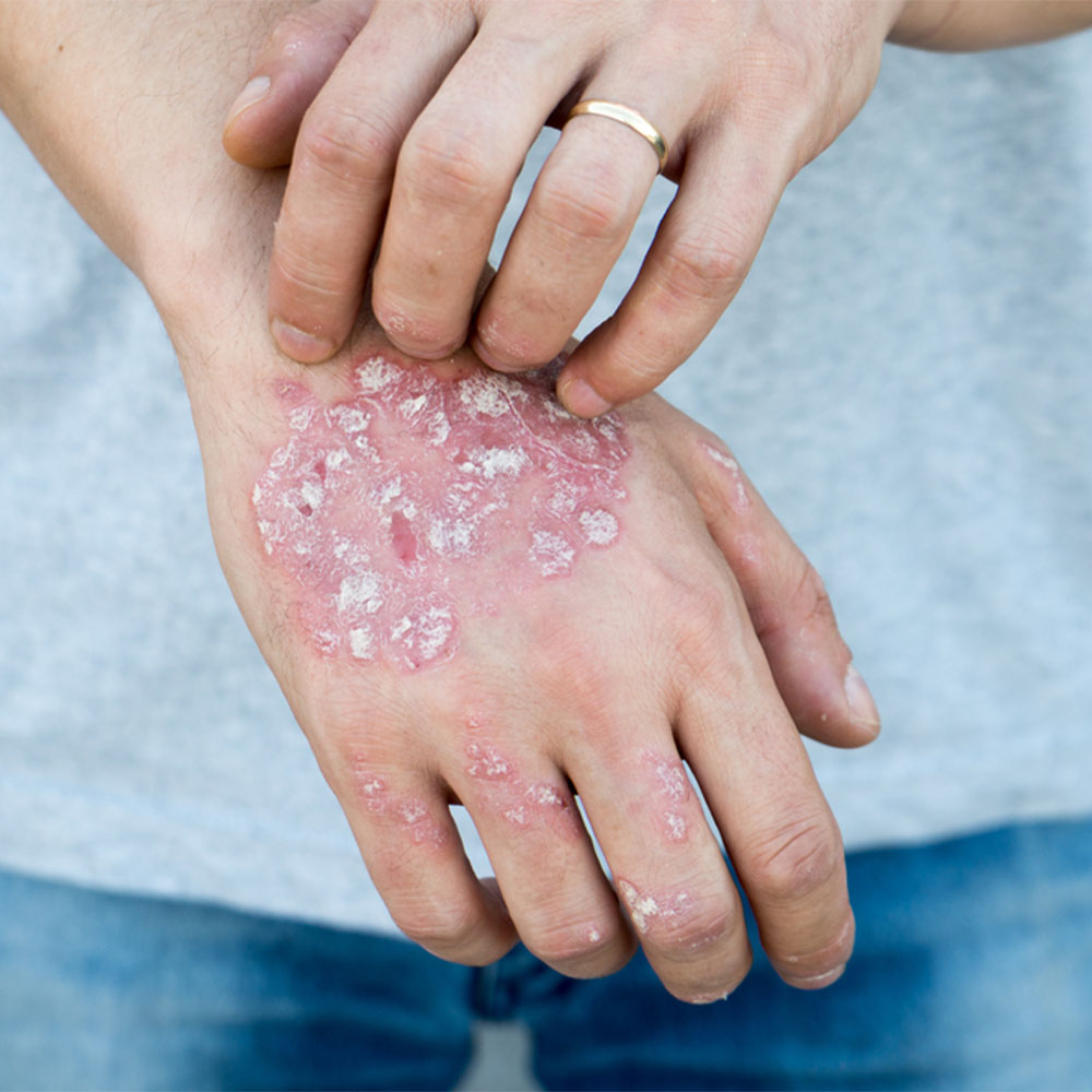 recent research on psoriasis